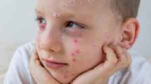 What is chickenpox and who can get an NHS vaccine?