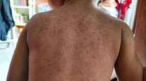 Unvaccinated pupils could be excluded from school as measles hits north London