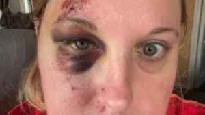 Injuries, blown tyres and repair bills - frustration over 'spike' in potholes