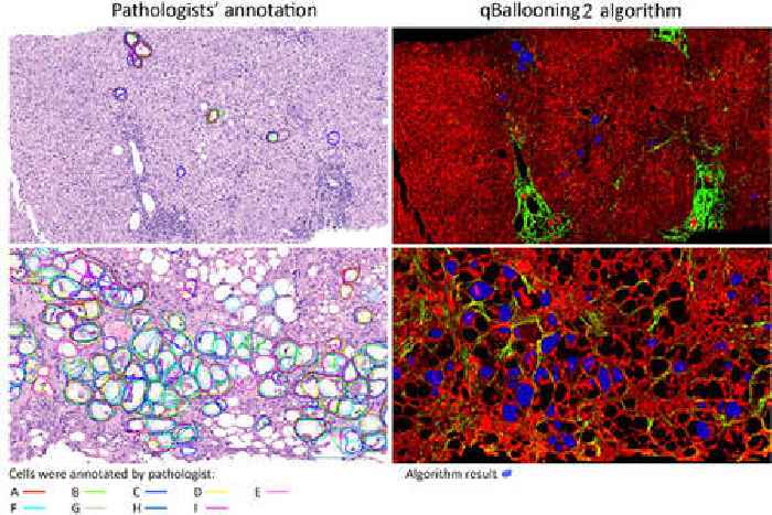 HistoIndex and Global Liver Experts Advance Stain-free AI Quantification of Hepatocyte Ballooning as a Reproducible Approach and Potential Endpoint for NASH Clinical Trials