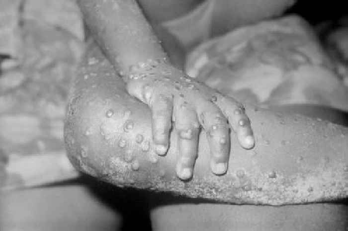 Monkeypox cases in the UK rise by more than double in last 48 hours