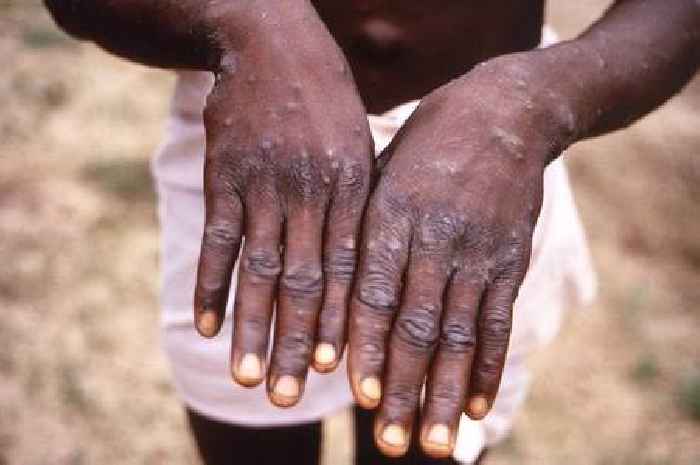 UK monkeypox cases 'to double' as WHO plans emergency meeting over outbreak