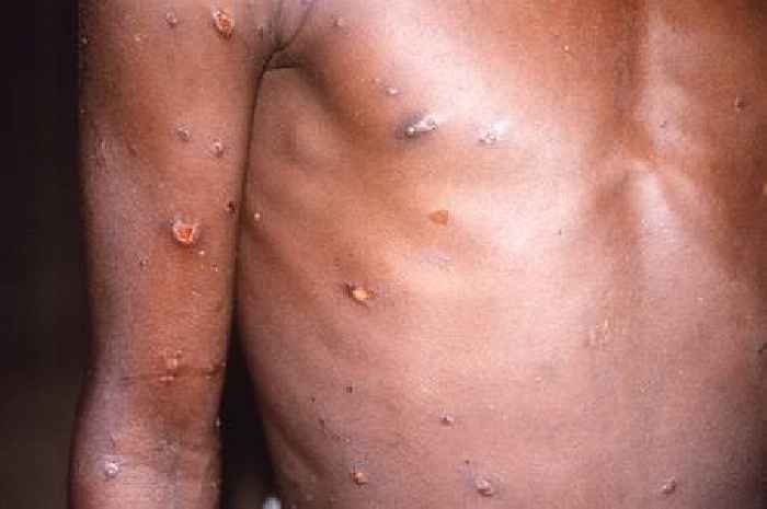Monkeypox could have 'massive impact' on sexual health