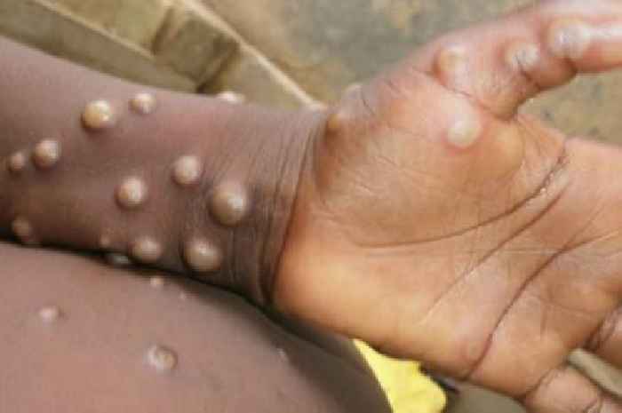 Monkeypox: UK Health Security Agency issues new advice ahead of cases update