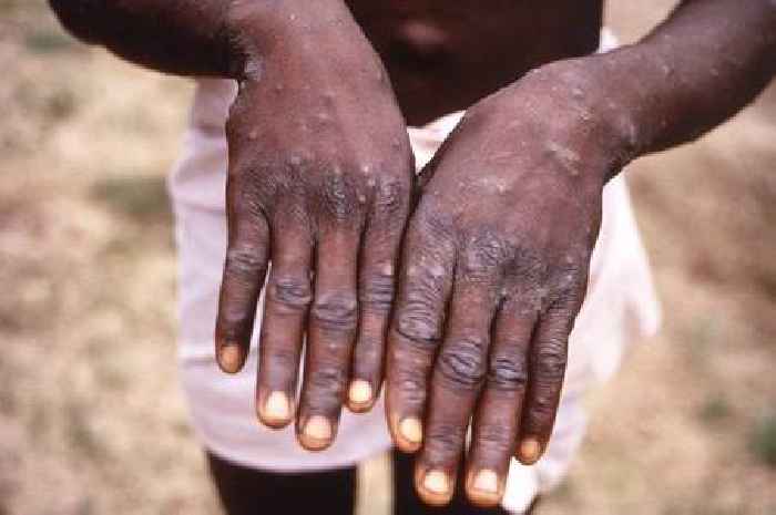 Monkeypox: High-risk contacts told to isolate for three weeks
