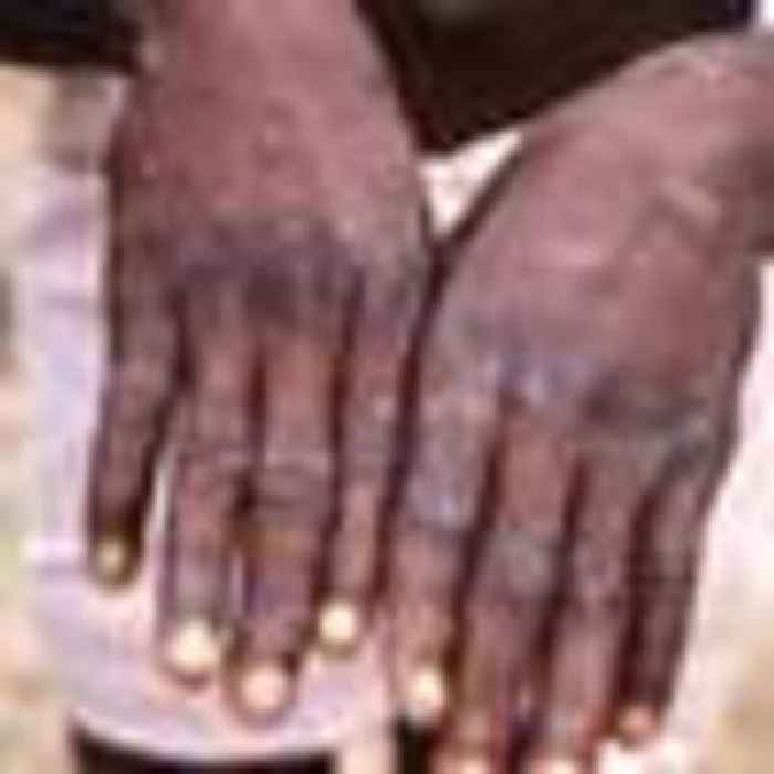 Big monkeypox cluster probably spread by sexual contact, Minister says