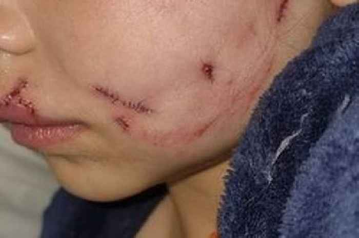 Girl, 4, scarred for life after being mauled by Jackador dog