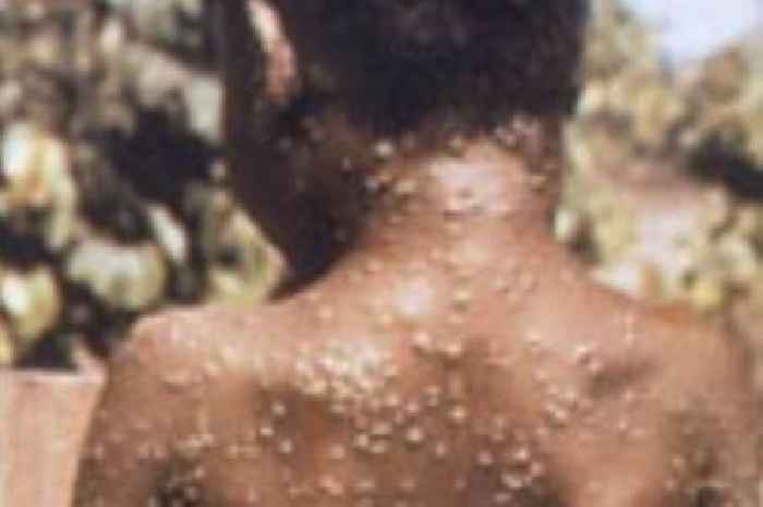 Monkeypox confirmed cases rising as health officials speak out on 'concerning' outbreak