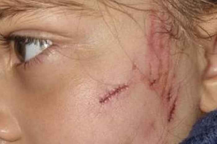 Little Scots girl suffers horrific facial wounds after dog attack in Glasgow garden