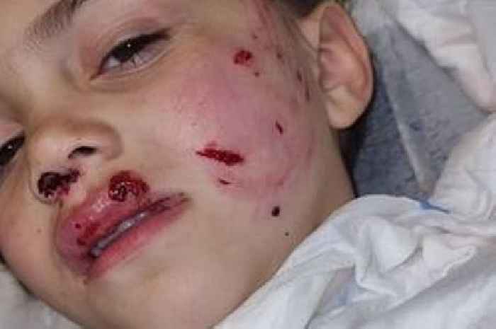 Four-year-old girl mauled by dog in garden left with horrific facial injuries