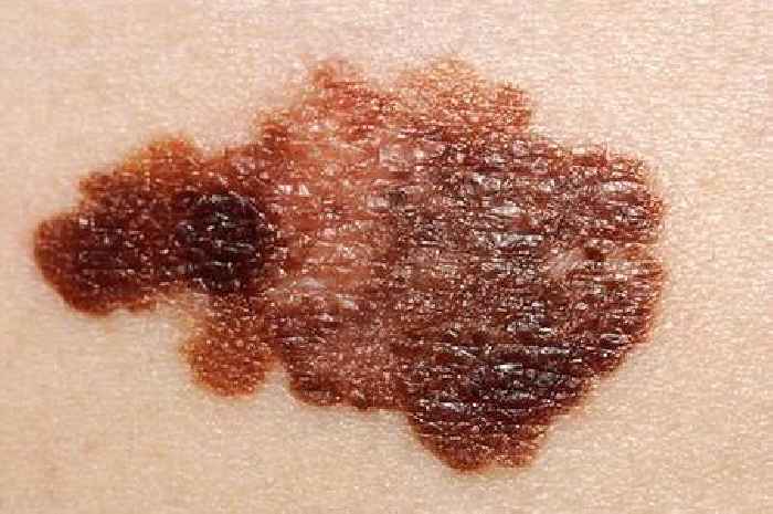 Doctor shares skin cancer 'red flag' signs on moles that could be early melanoma