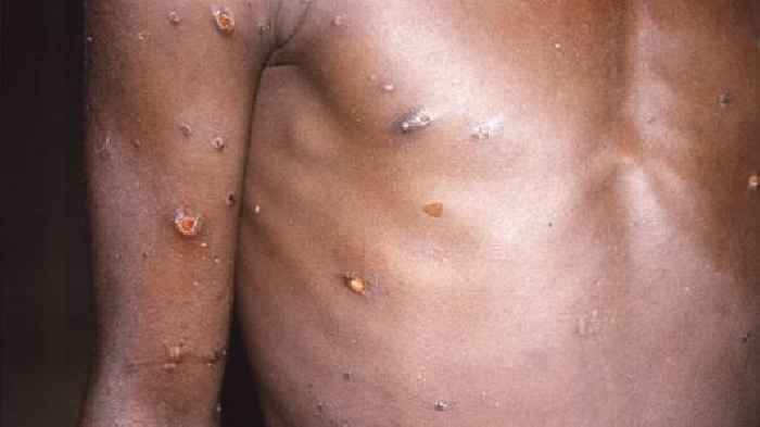 WHO: Nearly 200 Cases Of Monkeypox In More Than 20 Countries