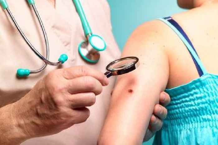 Doctor explains 'red flag' skin cancer signs to watch for on moles