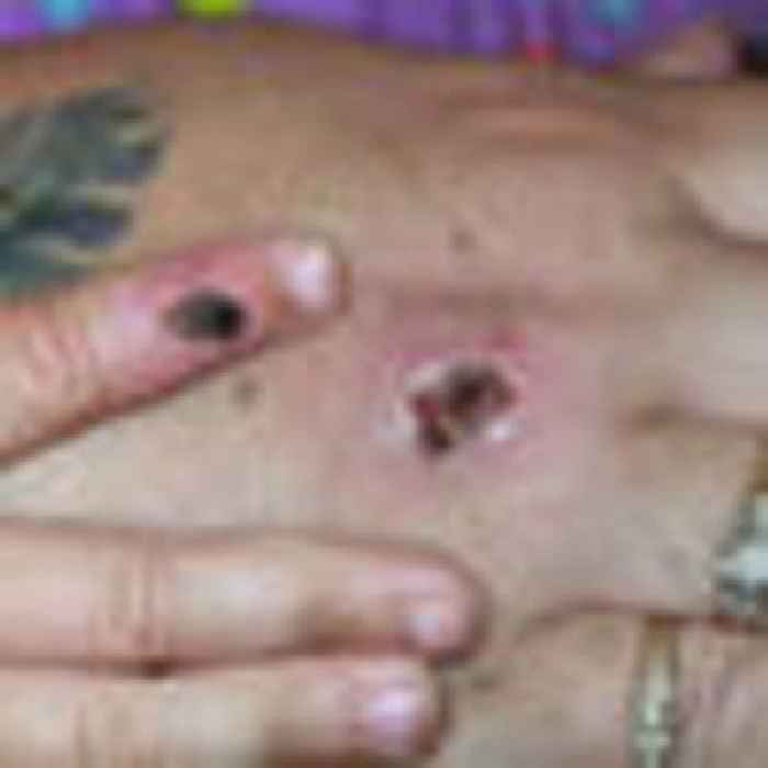 Monkeypox not related to shingles or Covid-19 vaccines
