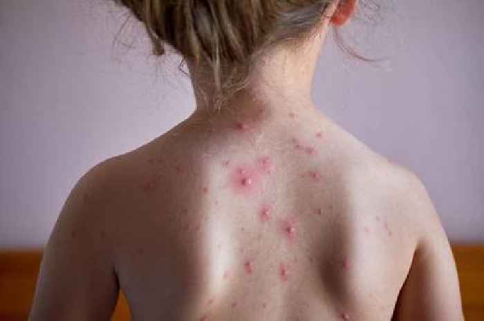 How to tell the difference between monkeypox and chickenpox in your child
