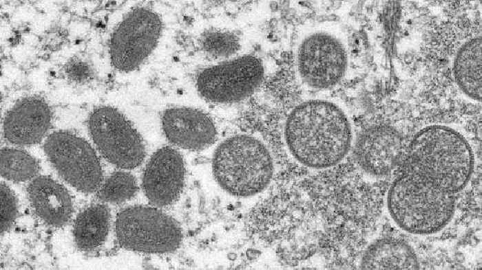 U.S. Officials Announce More Steps Against Monkeypox Outbreak