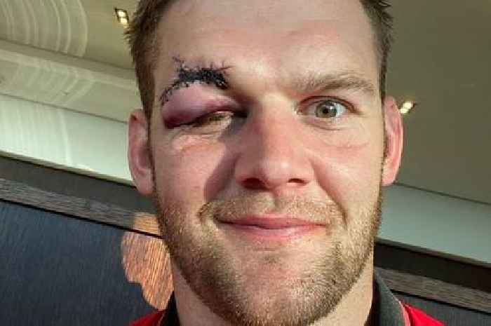 Today's rugby news as Dan Lydiate reveals brutal facial injury and Jason Robinson backs Regan Grace to succeed