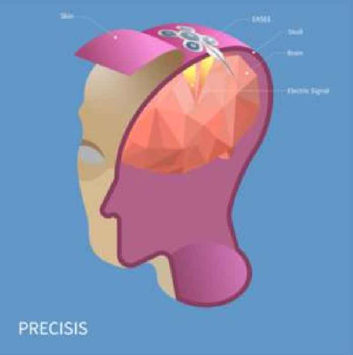 PRECISIS GmbH: EASEE - ­­­World's First Minimally Invasive Brain Pacemaker for the Treatment of Epilepsy Receives CE-Certification and is Available Immediately