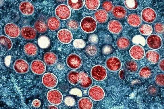Rise in Kent and Medway Monkeypox cases sparks call for campaign targeting LGBT men