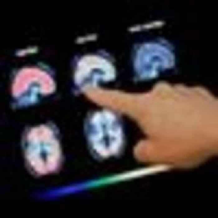 'Momentous and historic': New Alzheimer's drug slows memory decline