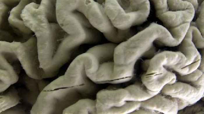 Scientists make key discovery in fighting brain diseases