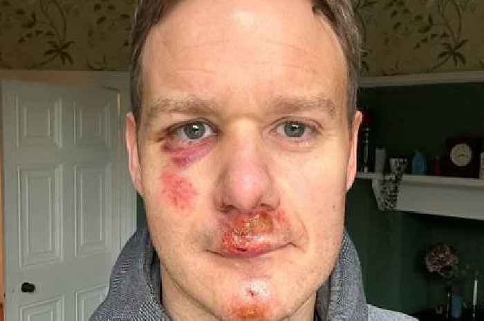 Dan Walker shares his first words after being knocked out cold in horror crash