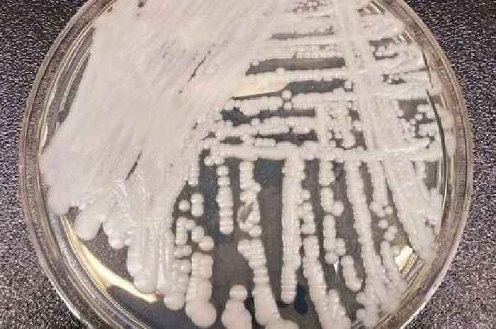 Candida auris: What are the signs and symptoms as deadly fungal infection spreads across US at 'alarming rate'