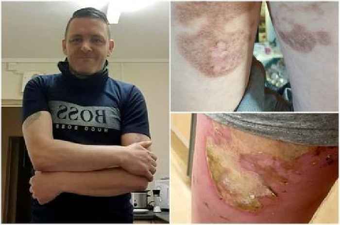 Russells Hall Hospital patient wins payout after treatment left him with 'unbearable' buttock burns