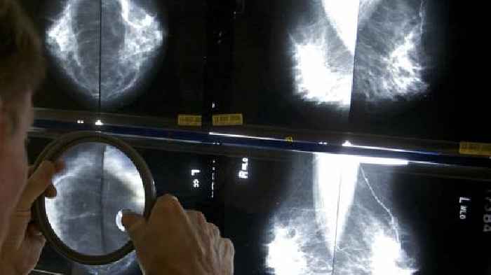 New recommended age for breast cancer screenings