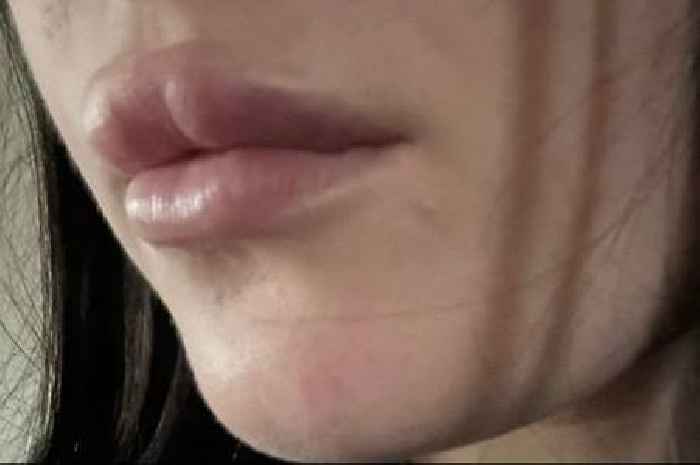 Woman's warning after lip filler left her unable to open her mouth