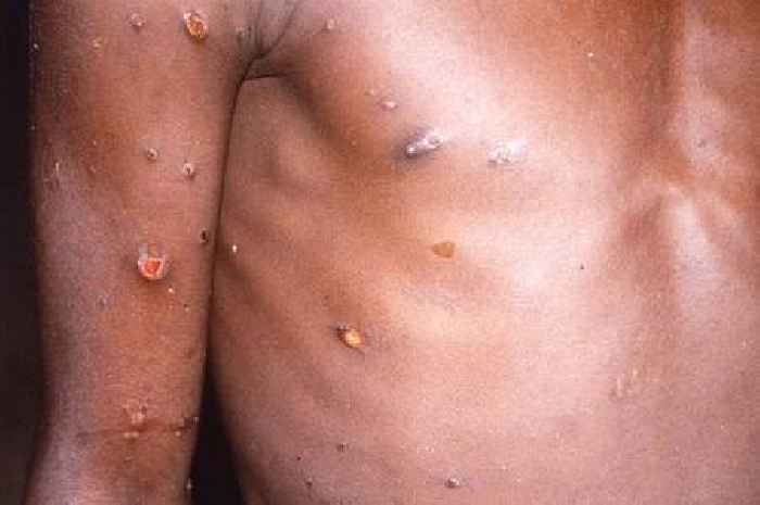 Call for new vaccine roll-out after spike in Mpox cases in UK