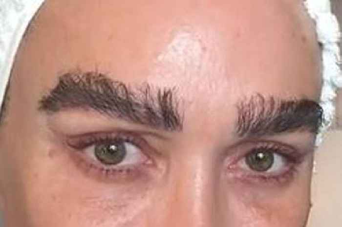 Mum has eyebrow transplant like Chrissy Teigen after 'accidentally shaving one off'