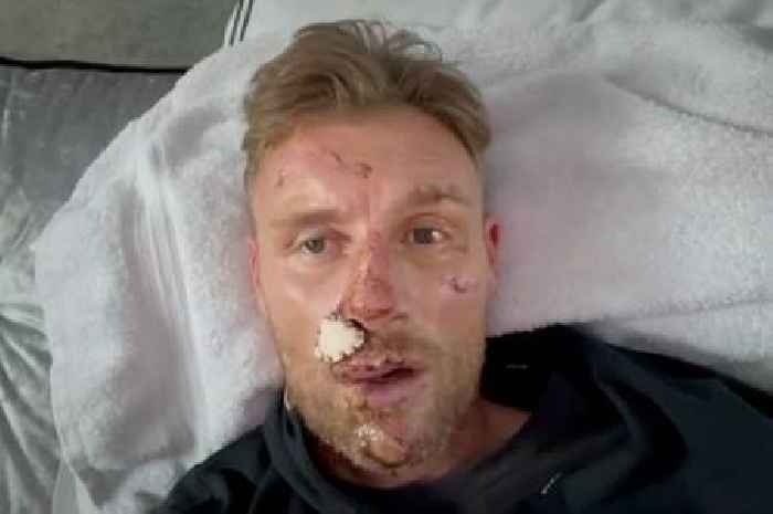 Freddie Flintoff shares extent of facial injuries right after Top Gear crash for first time