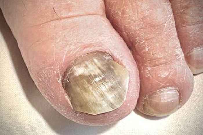 Defeat toenail fungus with £3.50 'miracle' item we use to treat cold and flu