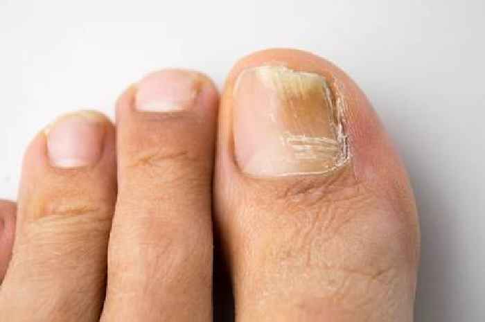 Common cold cure could help tackle annoying and painful nail fungus