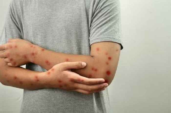 Mpox: Why 'Human Monkeypox' virus behind latest global health emergency changed names