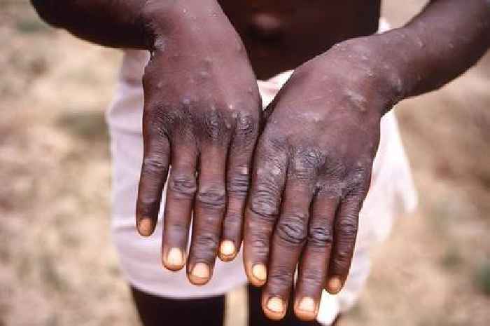WHO update as 100 cases of mpox found in Europe amid health emergency