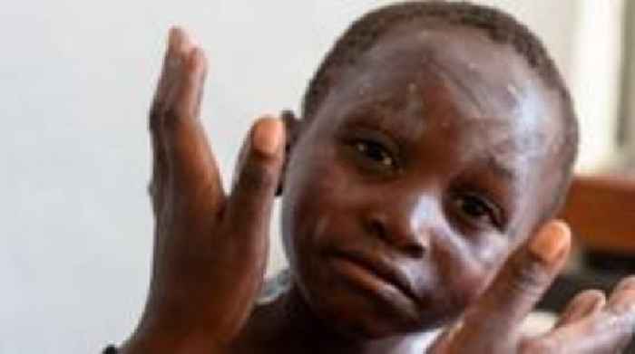 How worried should we be about mpox?