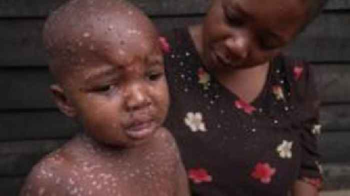 The children bearing the brunt of the mpox outbreak