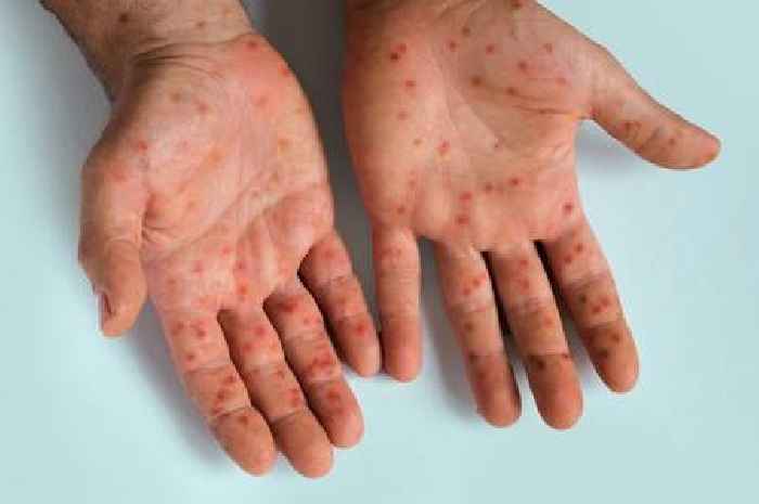 Welsh Government issues update about mpox