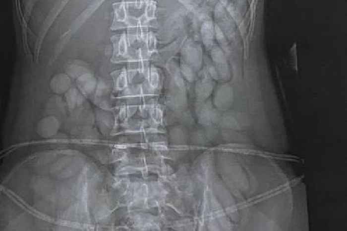 Woman arrested as X-ray shows dozens of 'cocaine bullets' in her stomach