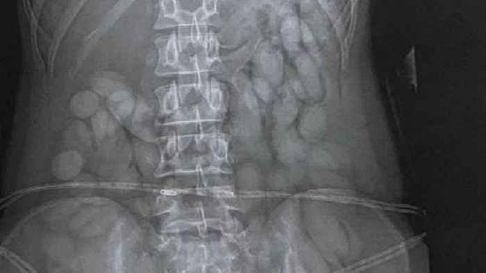 X-ray reveals 'cocaine bullets' in woman's stomach