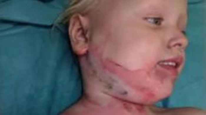 Mum of girl burned by firework warns of dangers