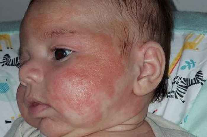 Eczema so bad baby looked like a burns victim until mum found answer