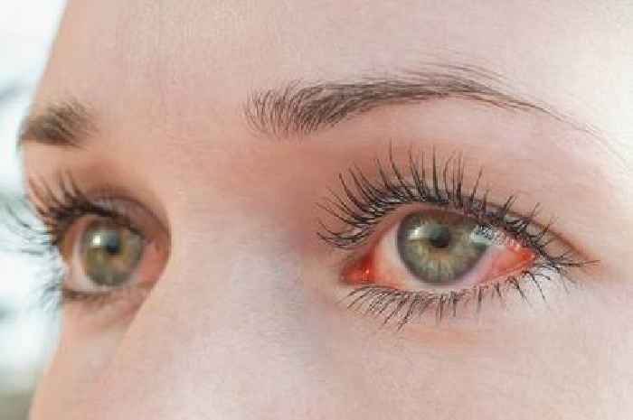 Doctor shares eye symptoms which could be sign of serious problem