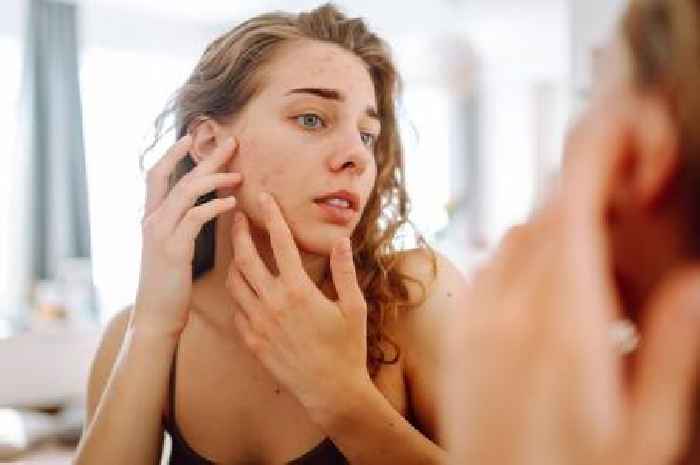Doctor shares five foods that could be triggering acne and spots