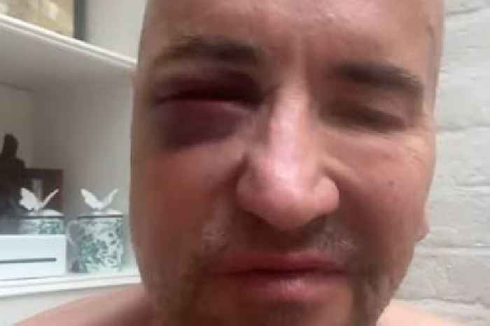 DJ Fat Tony shows horrific facial injuries after 'being attacked by rival'