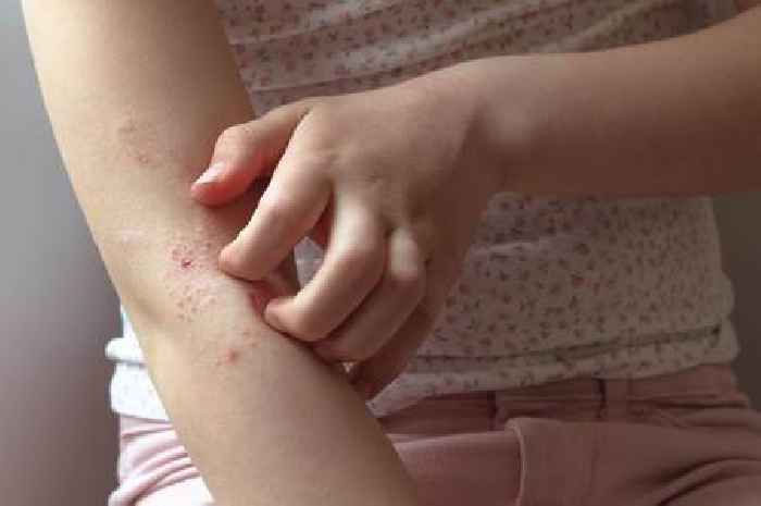 Mum shares 'cure' for daughter's eczema she thought was an 'old wives' tale'