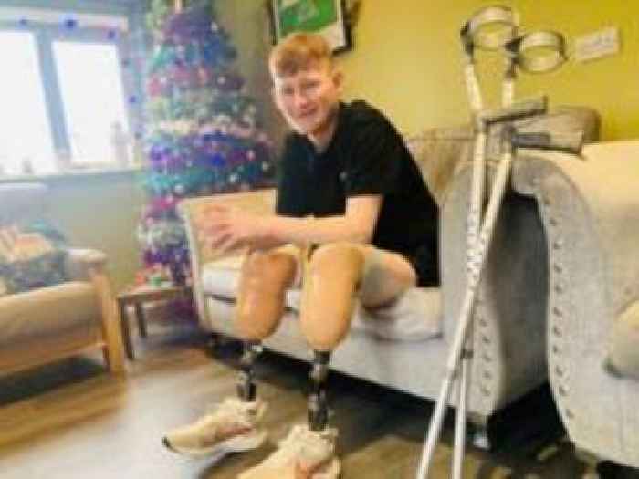 Teenager adapting to life with prosthetic legs