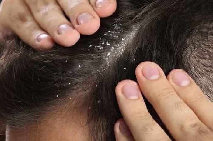 NHS tells people with dandruff that four ingredients could help stop it